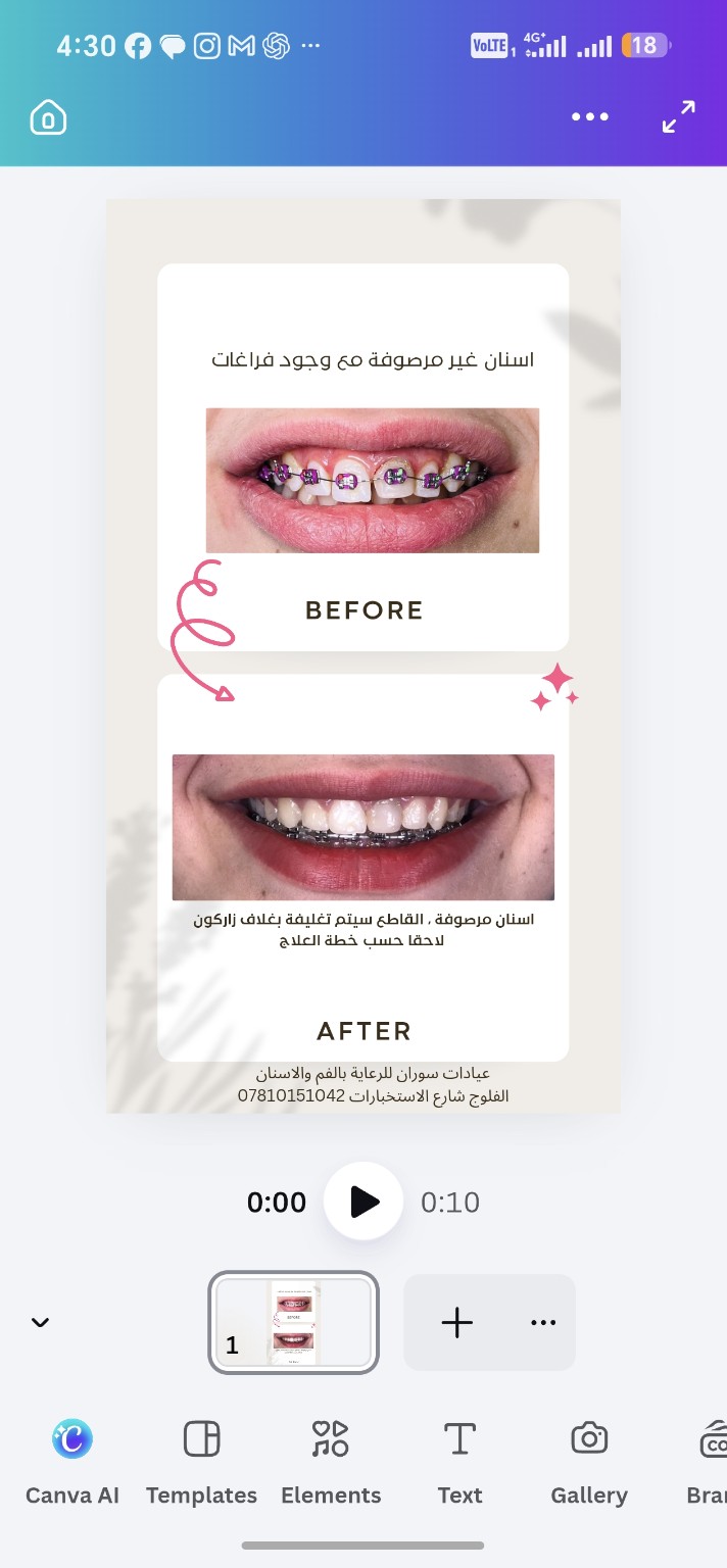 تحسين اصطفاف الأسنان — قبل العلاج