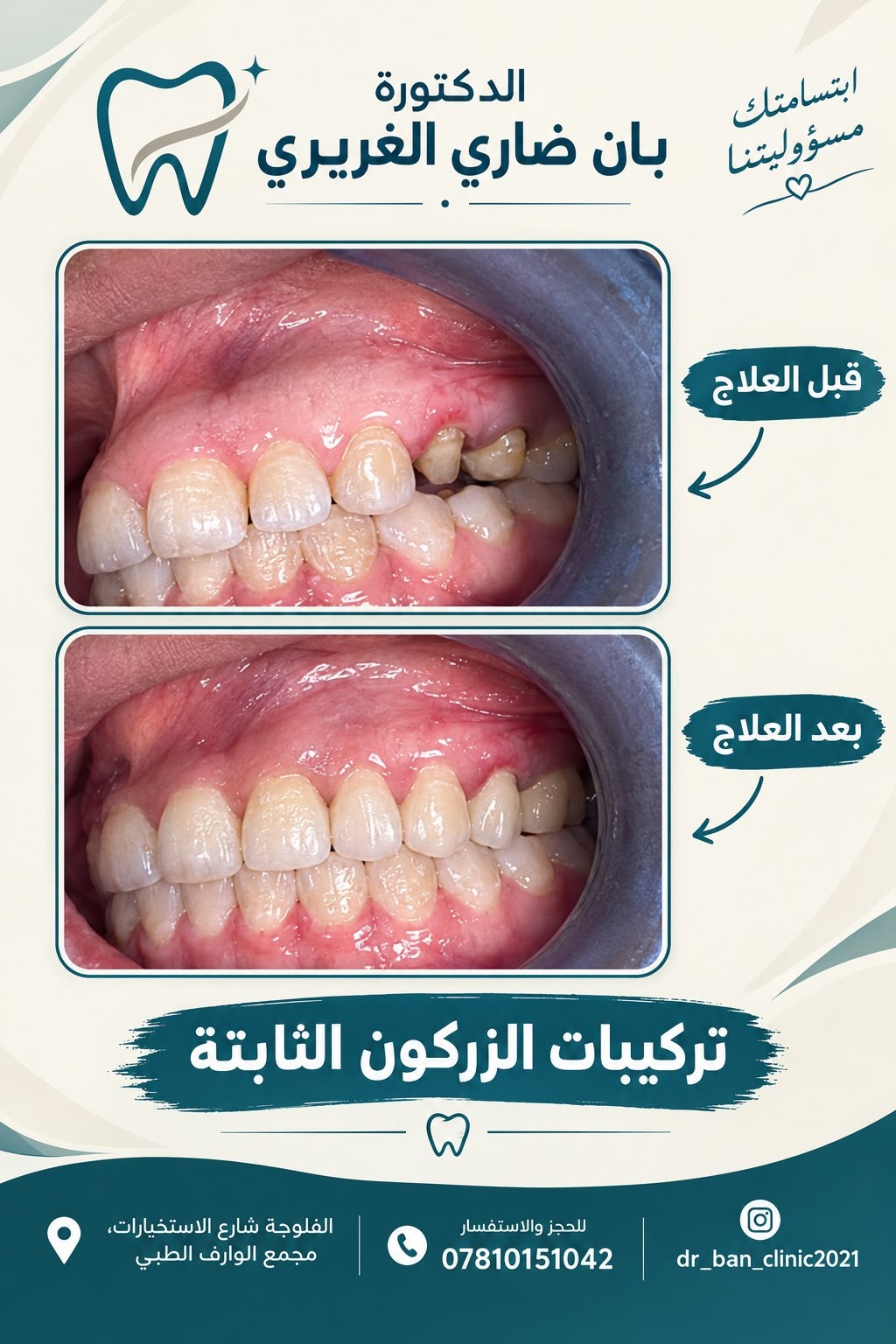 قبل وبعد تركيبات الزركون الثابتة مع د. بان ضاري الغريري في عيادات سوران
